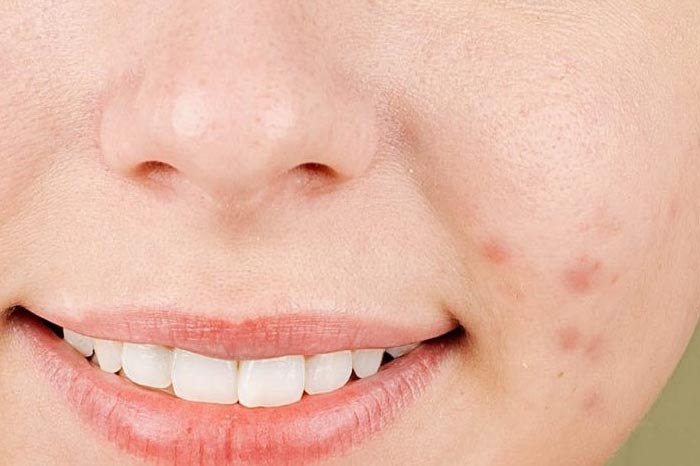 사춘기 여드름, 부모가 도와줄 수 있는 것들 ···