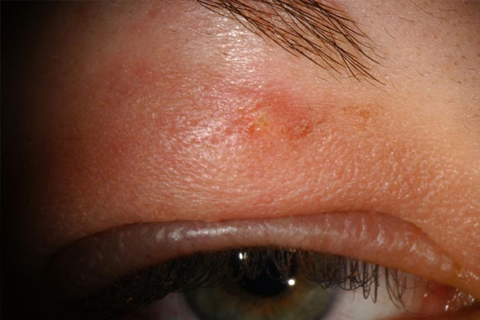 봉와직염은 단순 염증이 아니다 – 빠른 치료가 필요한 이유