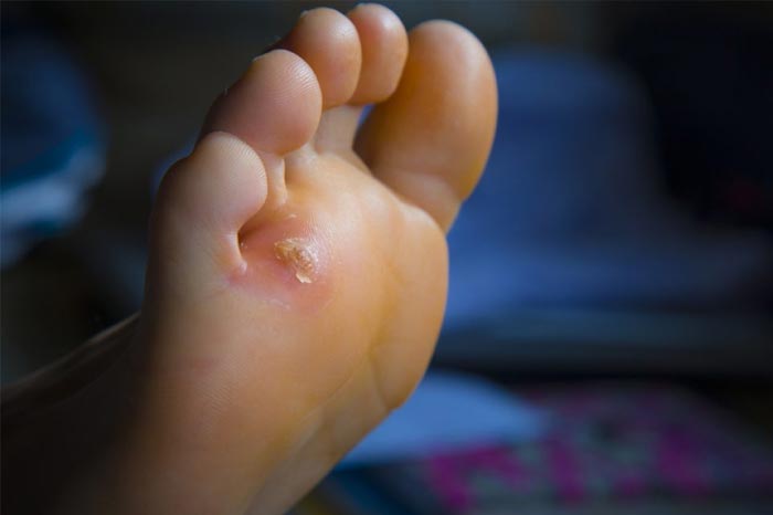 티눈과 굳은살, 어떻게 다르고 어떻게 치료할까?