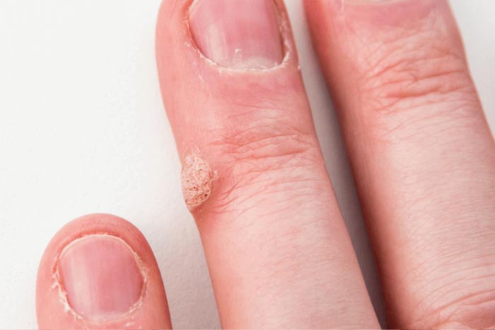 바이러스성 사마귀, 종류부터 제거까지 알아보기